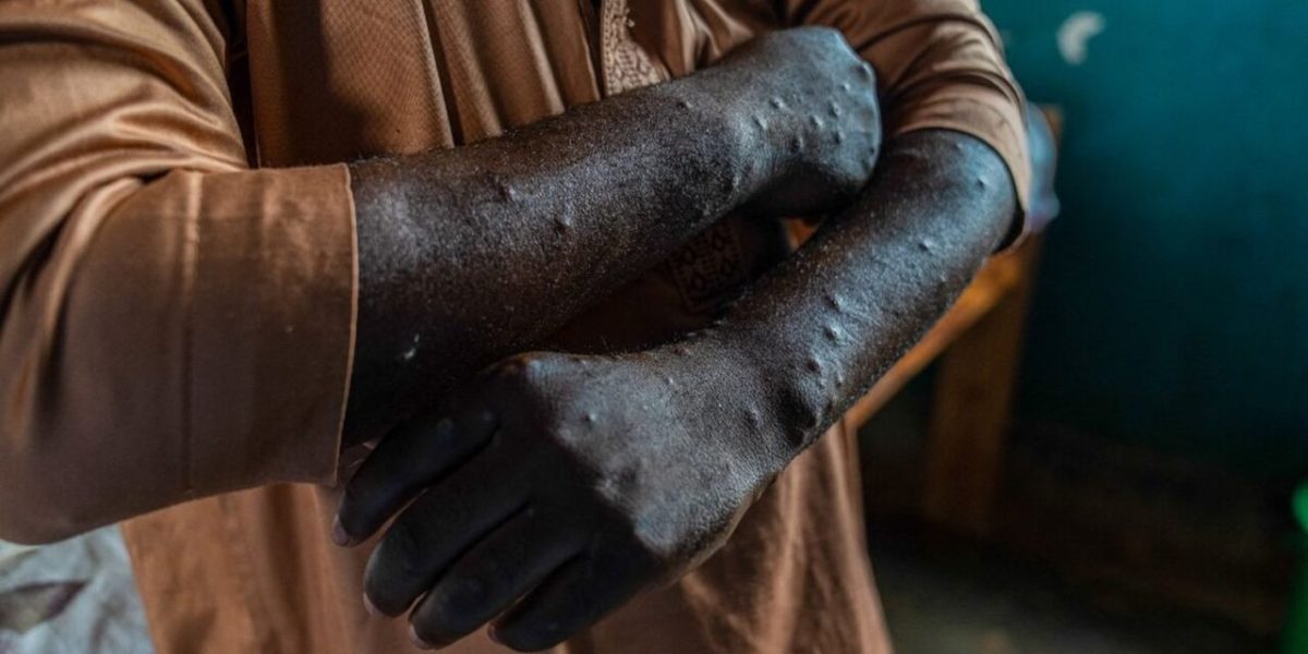 Two New Mpox Cases Reported in Réunion, Vaccination Campaign Begins