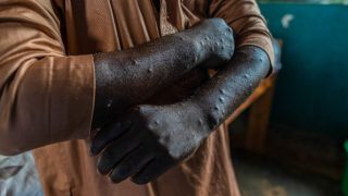 Two New Mpox Cases Reported in Réunion, Vaccination Campaign Begins